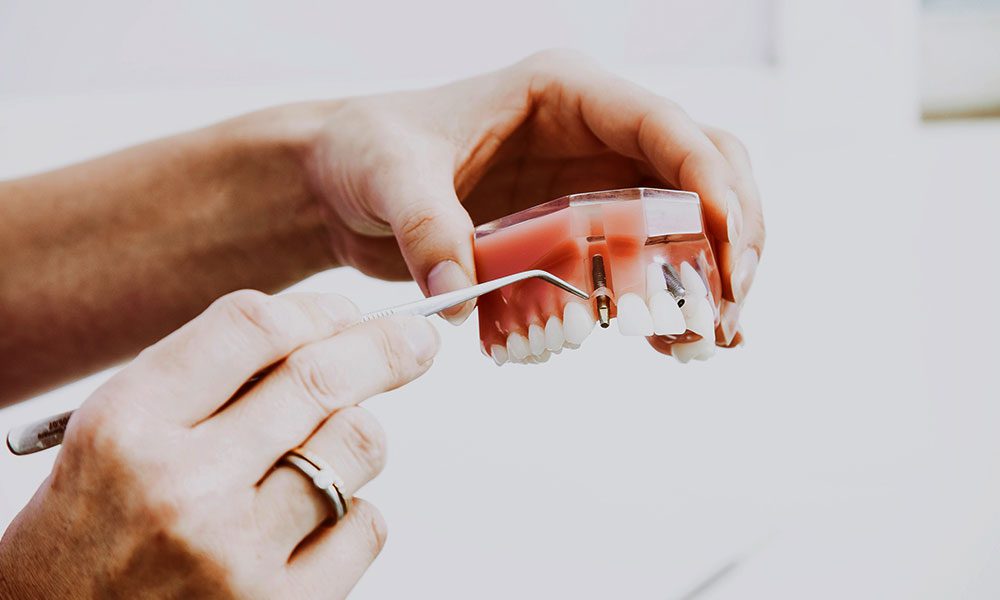 Dental Lavelle The Importance of Replacing Missing Teeth